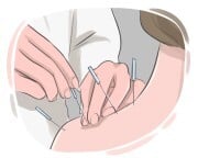 acupuncture