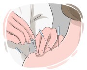 acupuncture