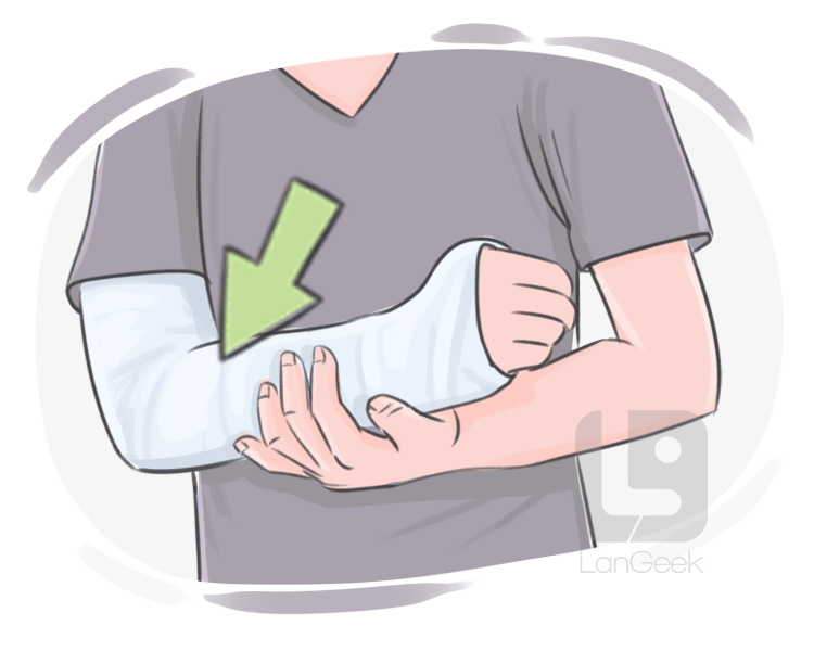 plaster bandage definition and meaning