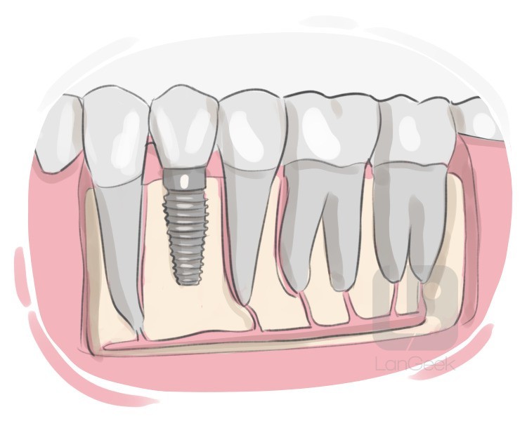 dental implant definition and meaning