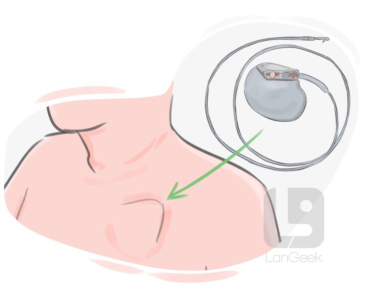 pacemaker definition and meaning