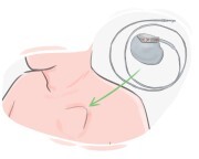 pacemaker