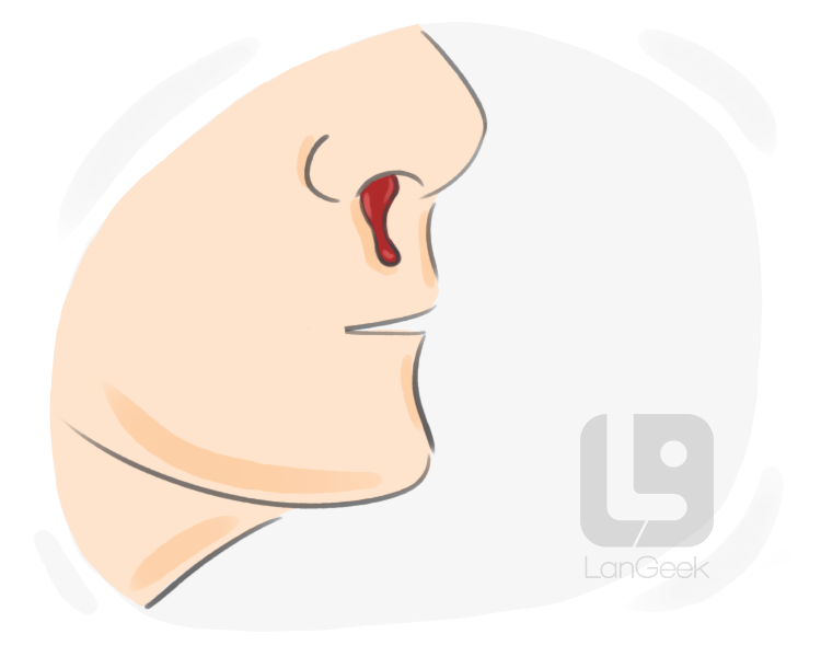 epistaxis definition and meaning