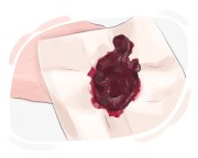 blood clot