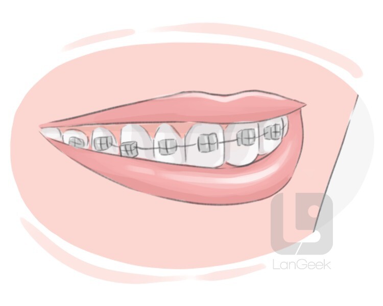 Definition & Meaning of "Orthodontic braces" LanGeek