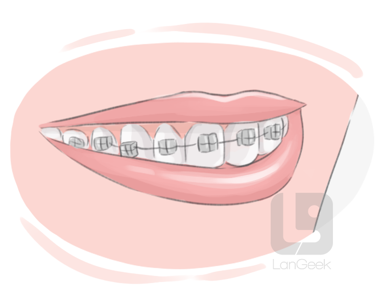 orthodontic braces definition and meaning
