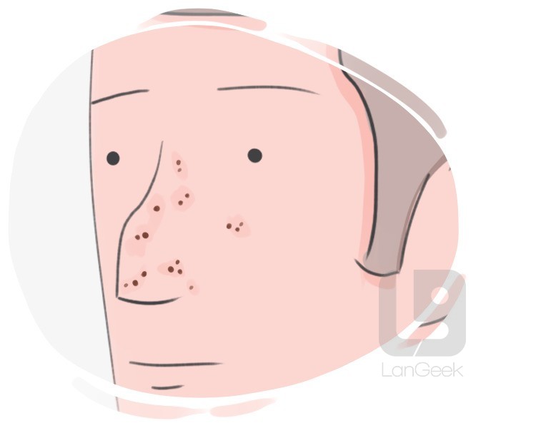 blackhead definition and meaning