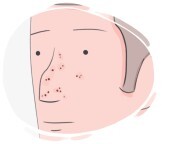 blackhead