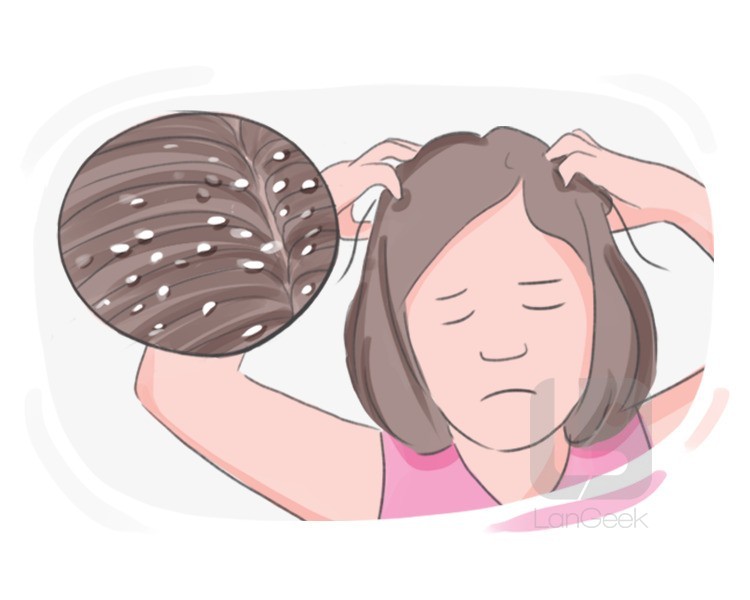 dandruff definition and meaning