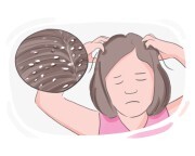 dandruff