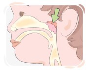 adenoid