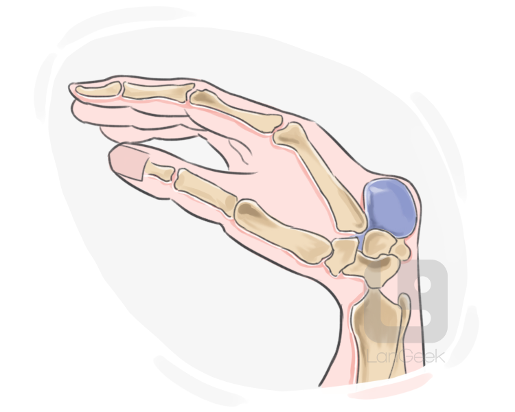 ganglion cyst definition and meaning