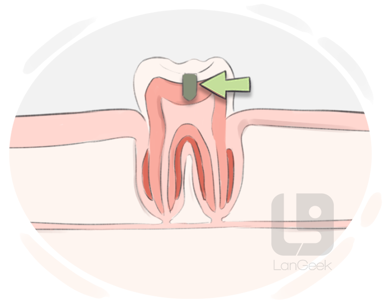 fissure cavity definition and meaning