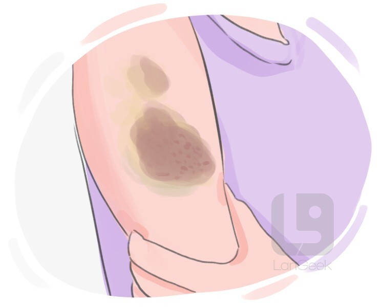 bruise definition and meaning