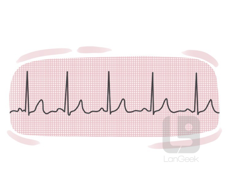 electrocardiogram definition and meaning