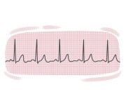 electrocardiogram