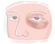 black eye