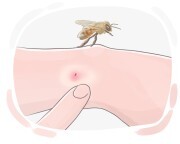 bee sting