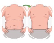 liposuction