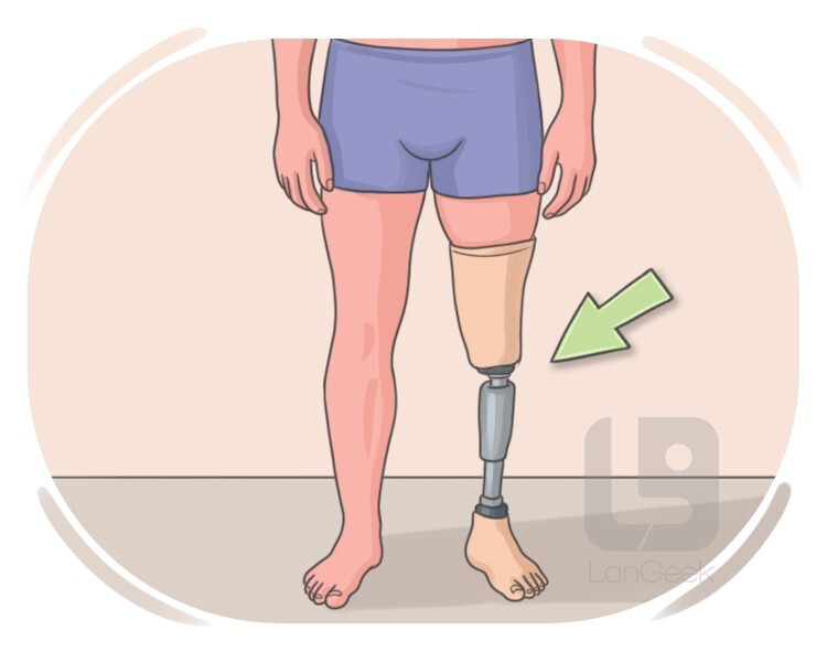 prosthesis definition and meaning