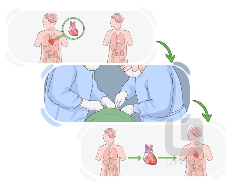 transplant definition and meaning